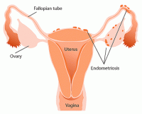 /album/hablando-de-endometriosis/endometriosis-diag-gif1/