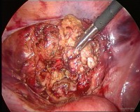 /album/hablando-de-endometriosis/endo-deep-vesicout4-jpg1/