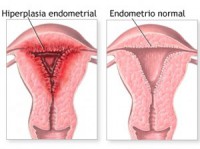 /album/hablando-de-endometriosis/que-es-la-endometriosis-300x224-jpg/