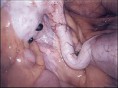 /album/fotogaleria/endometriosis2-jpg/